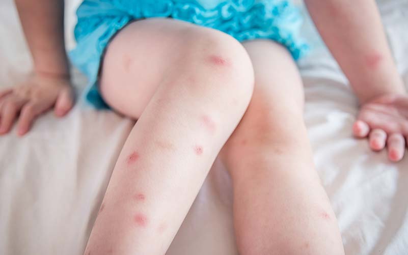 Red welts along a child's leg caused by bed bug bites