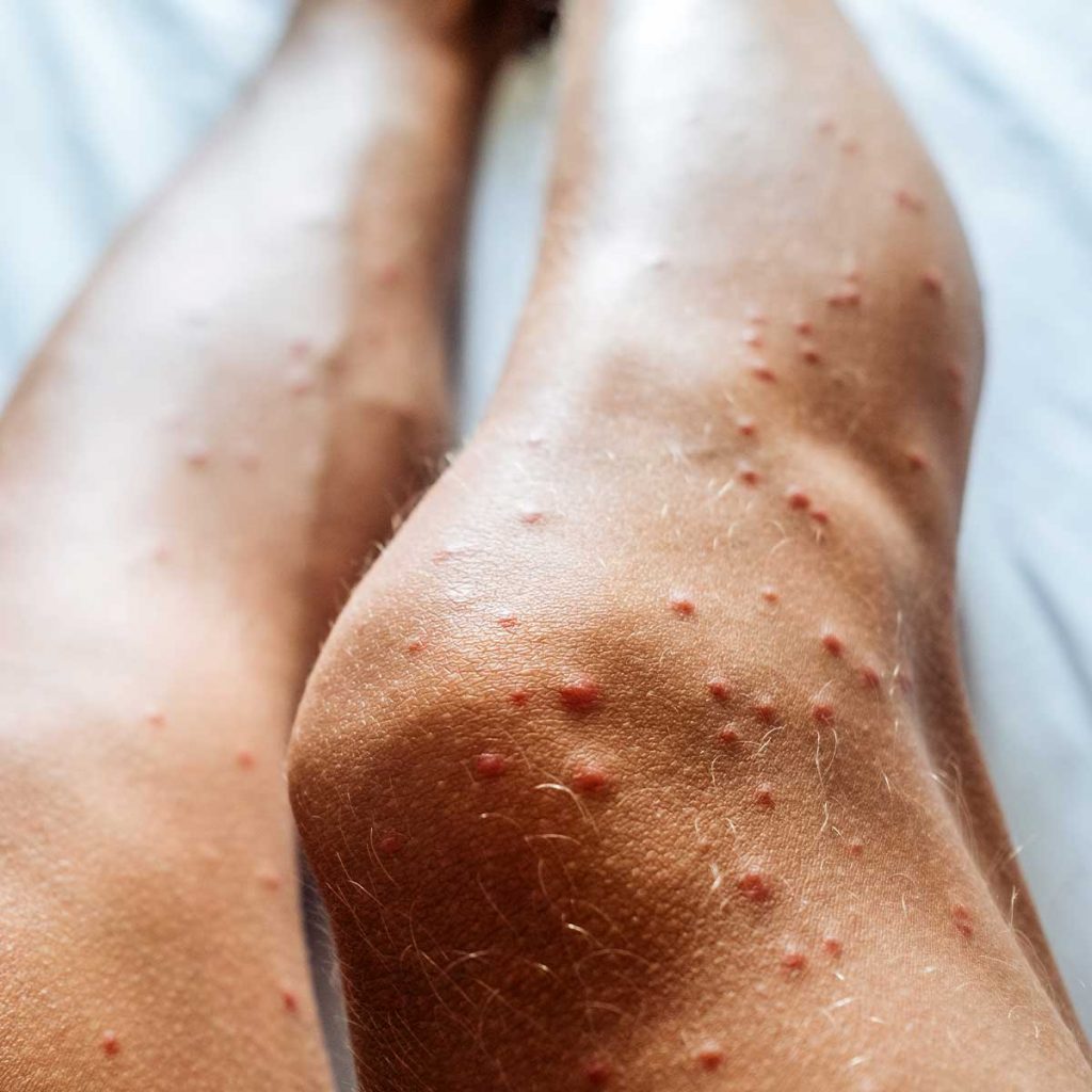 Where Do You Get Bed Bugs From? - When bed bugs bite they leave your skin looking undesirable like the picture shows.